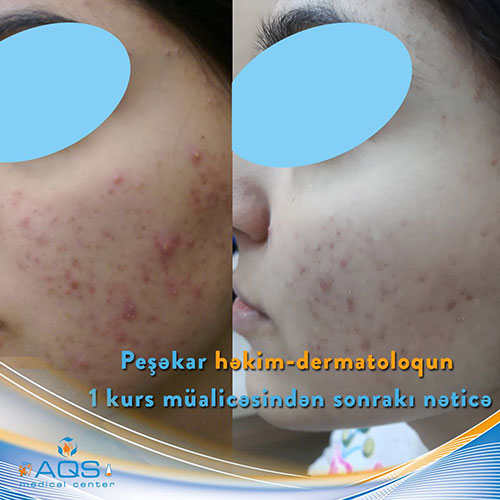 Dermatoloji Müalicə